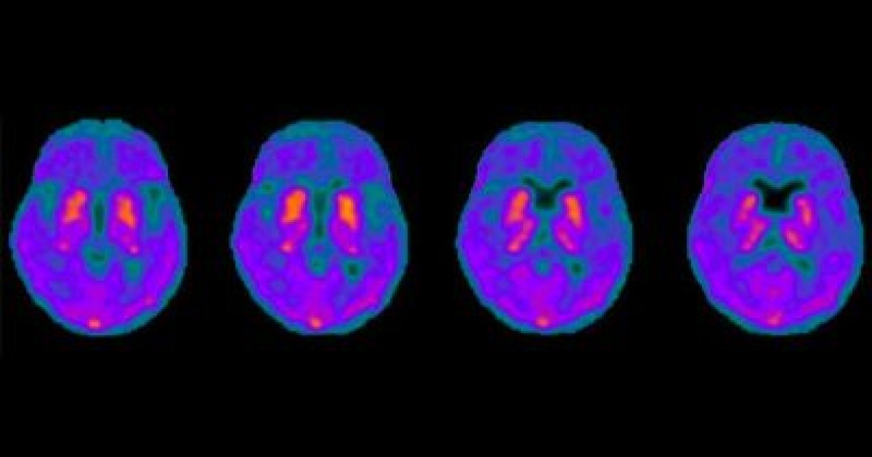 Brain Tau PET